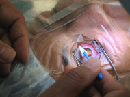 התאוששות מניתוח הסרת משקפיים בלייזר