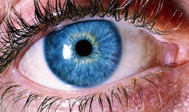 מהו ניתוח לייזר לשינוי צבע עיניים ומה מטרתו?